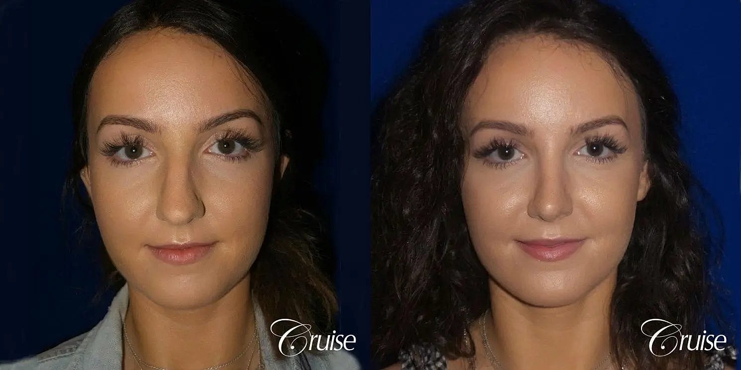 Rhinoplasty Before & After