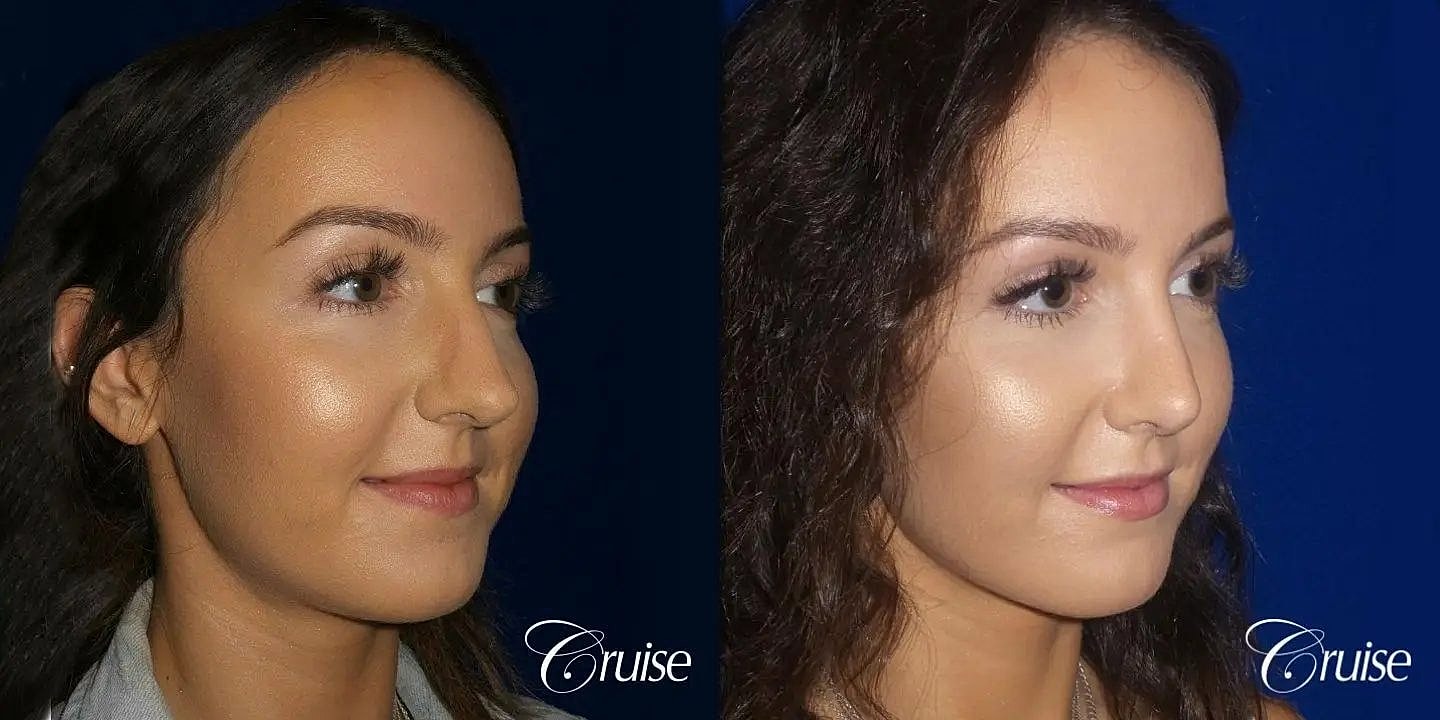 Rhinoplasty Before & After