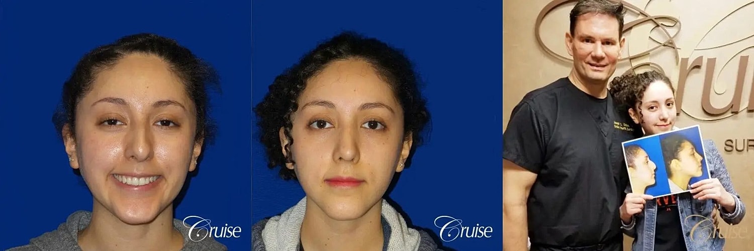 Rhinoplasty Before & After