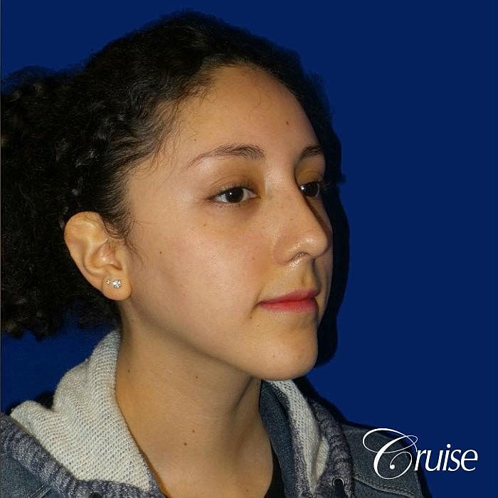 Rhinoplasty Before & After