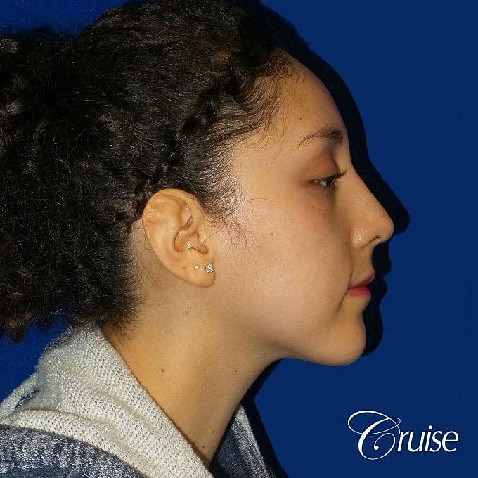 Rhinoplasty Before & After