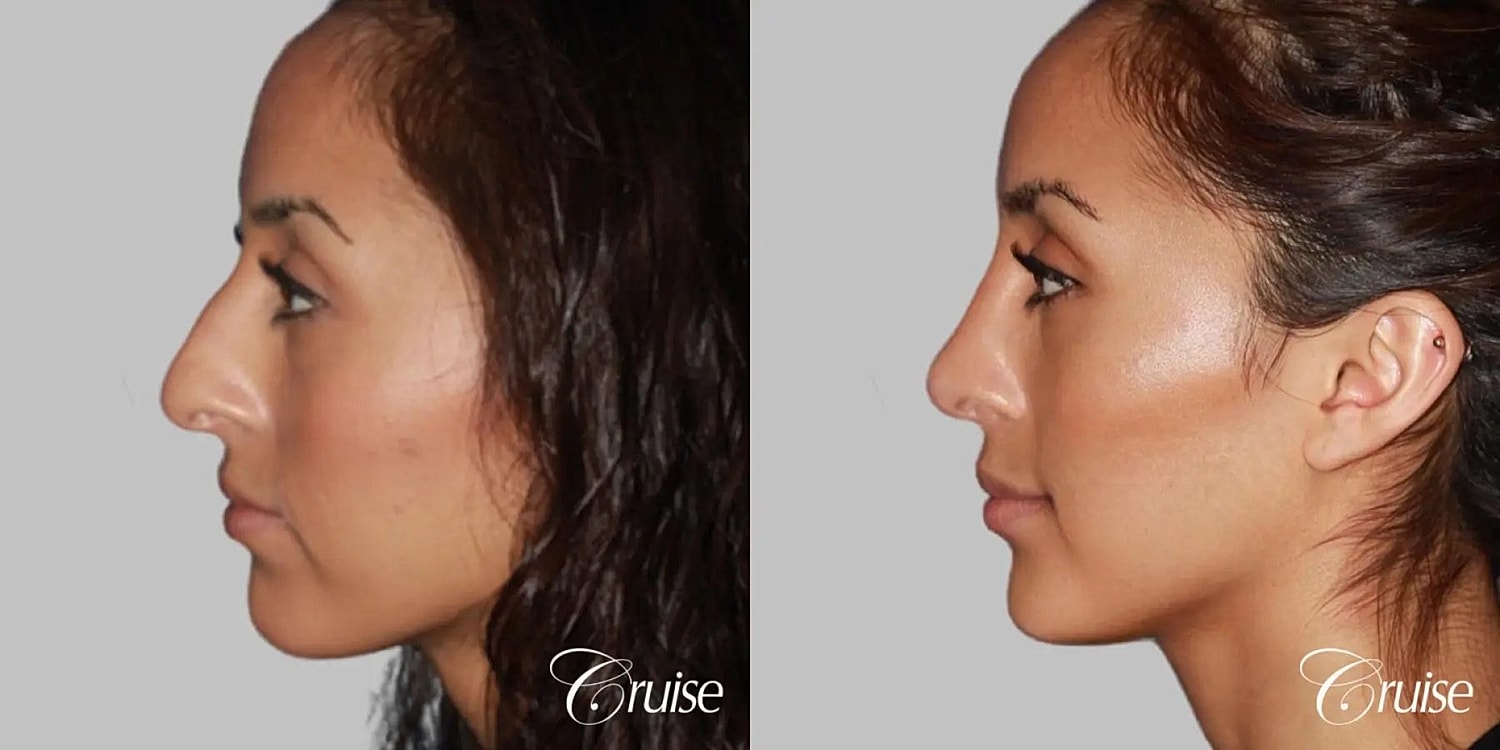 Rhinoplasty Before & After