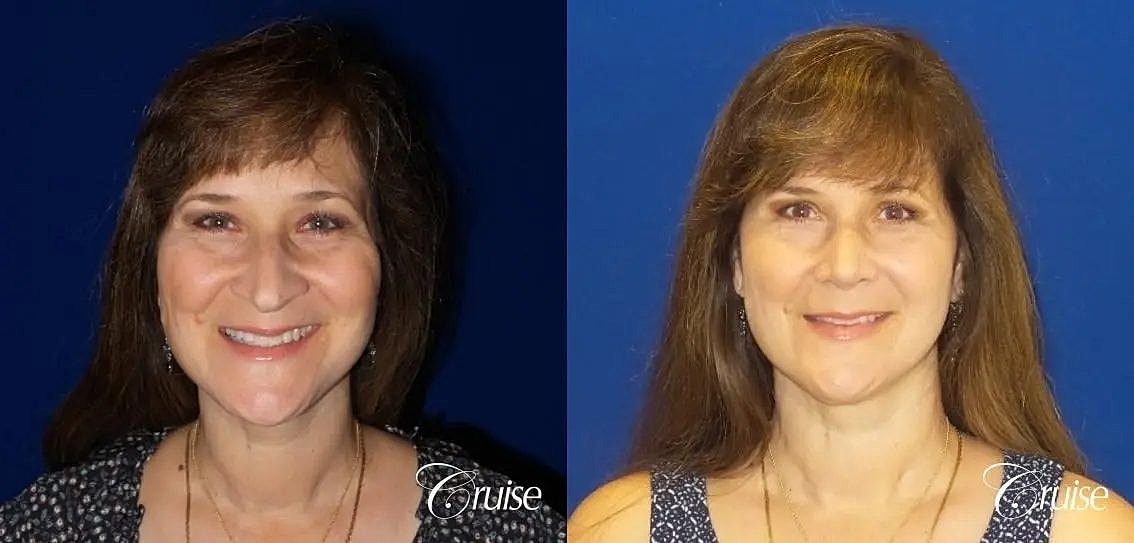 Rhinoplasty Before & After