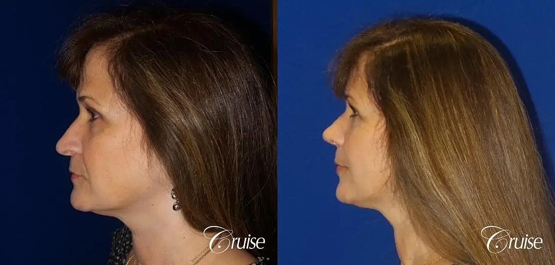 Rhinoplasty Before & After