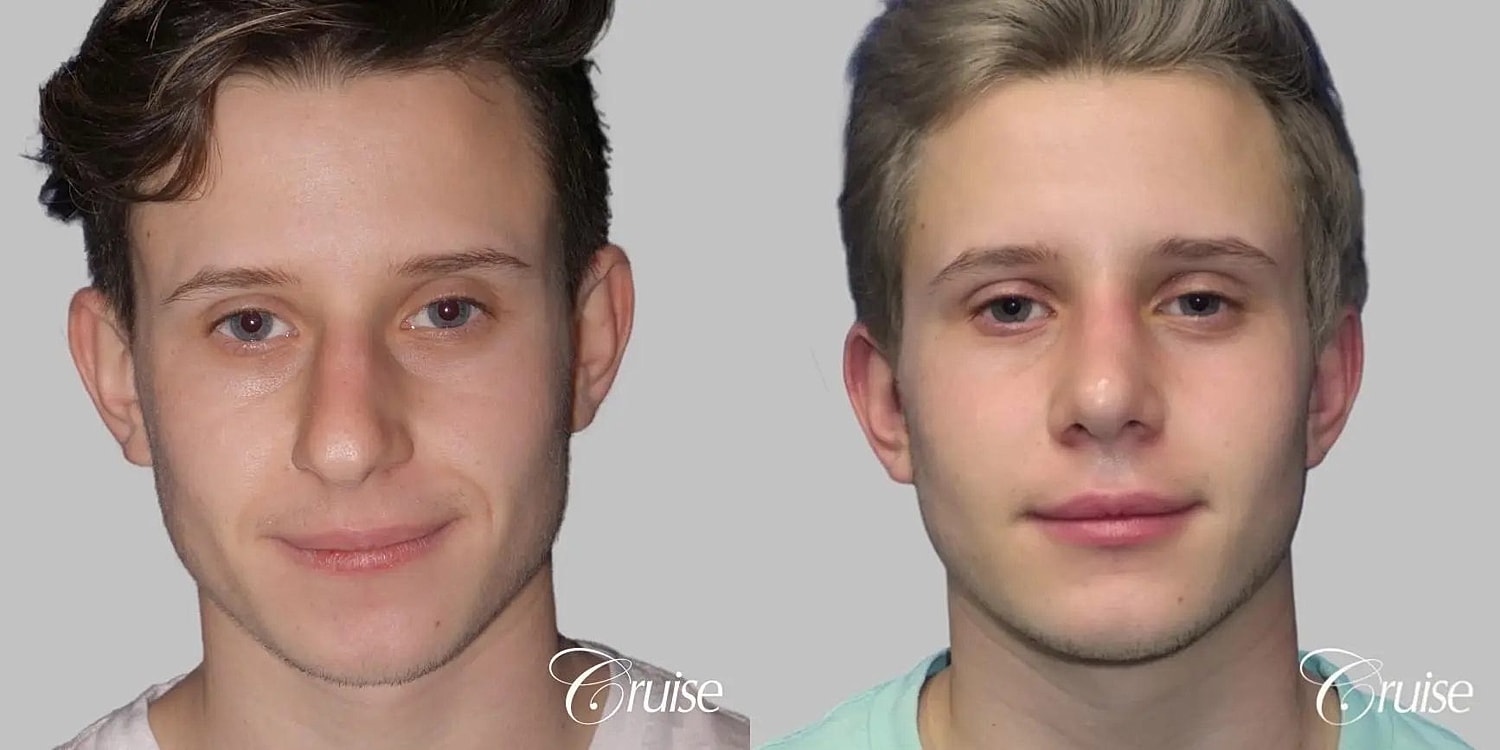 Rhinoplasty Before & After