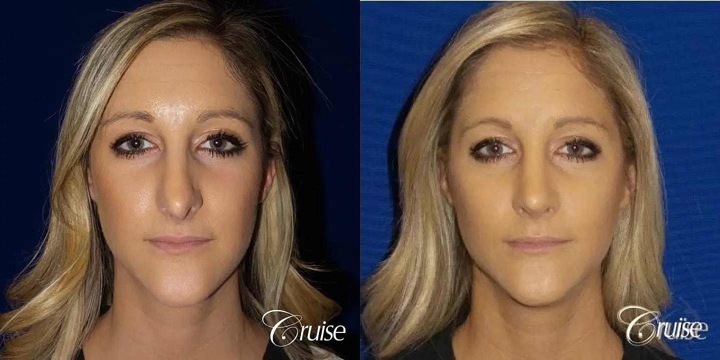 Rhinoplasty Before & After