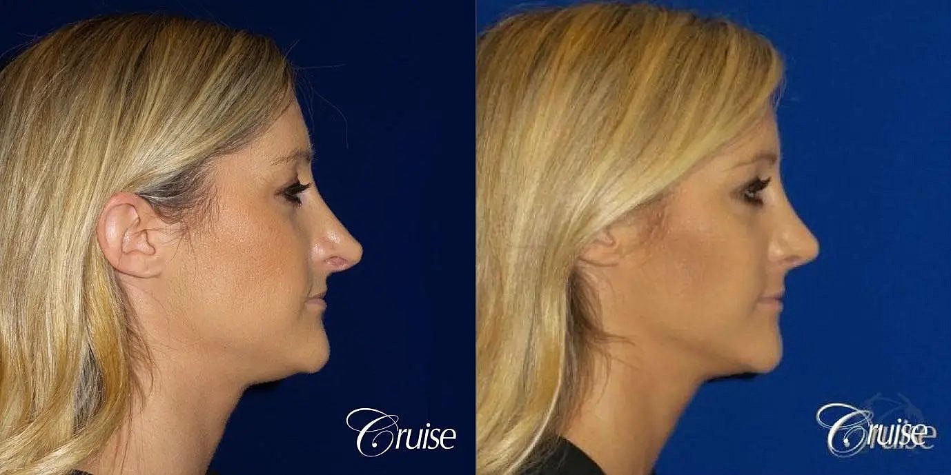 Rhinoplasty Before & After