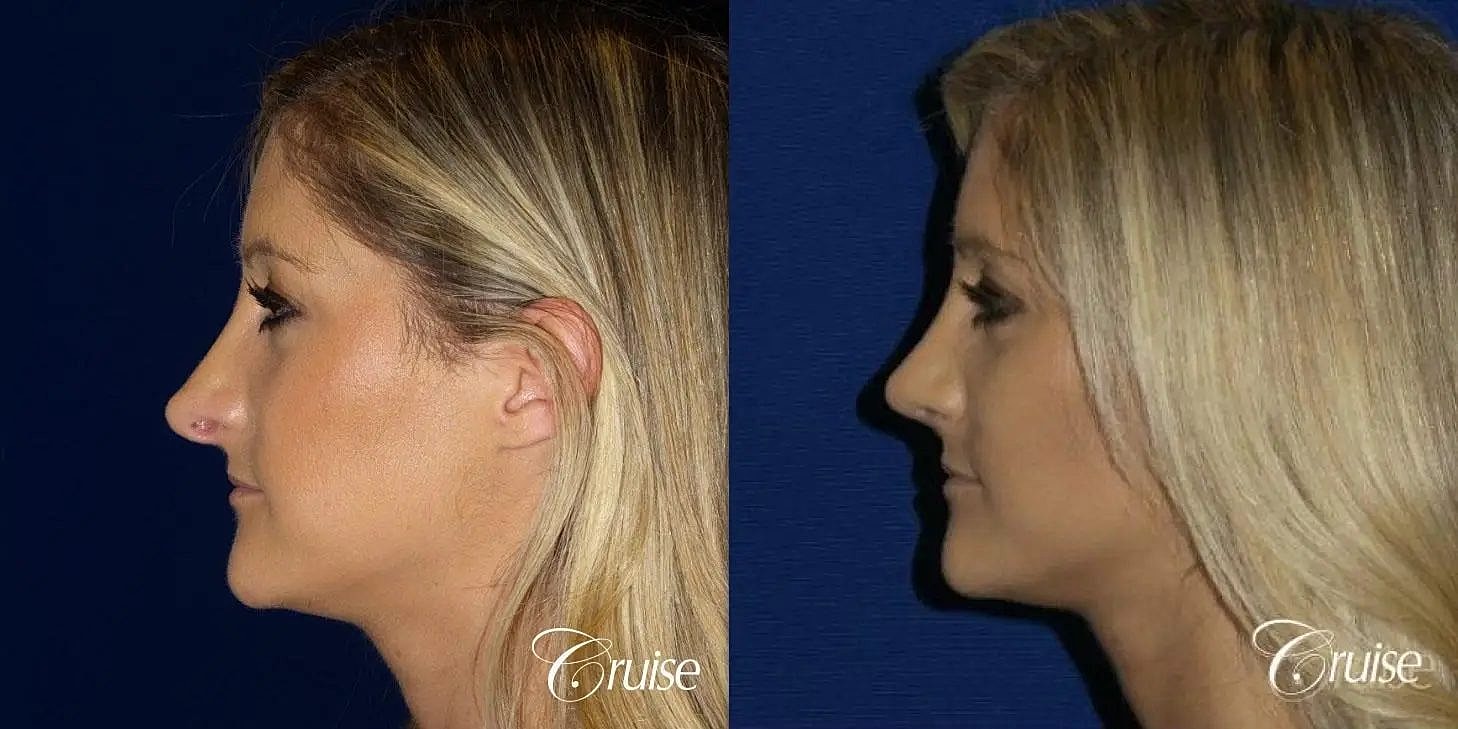 Rhinoplasty Before & After