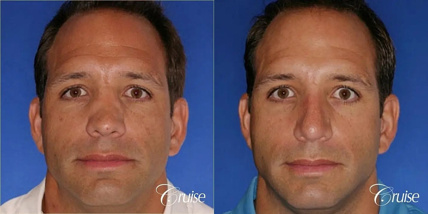 Rhinoplasty Before & After