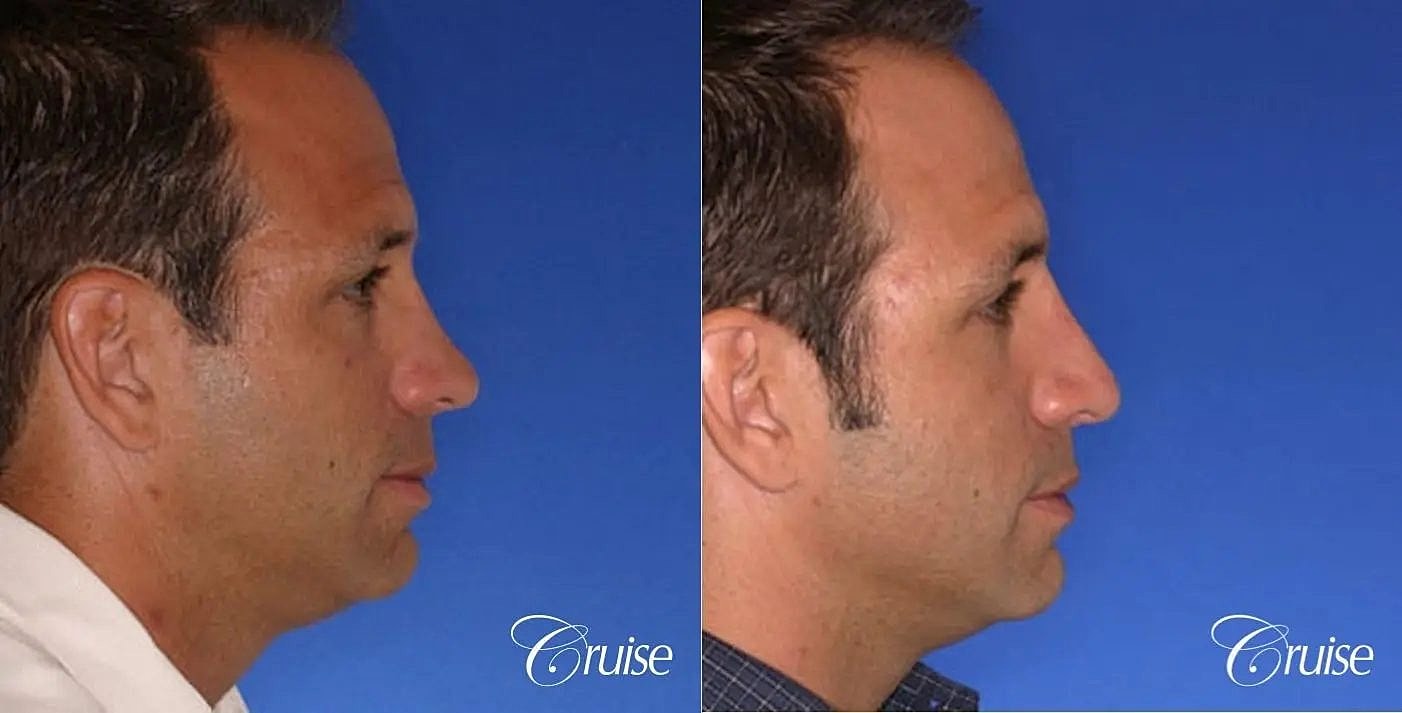 Rhinoplasty Before & After