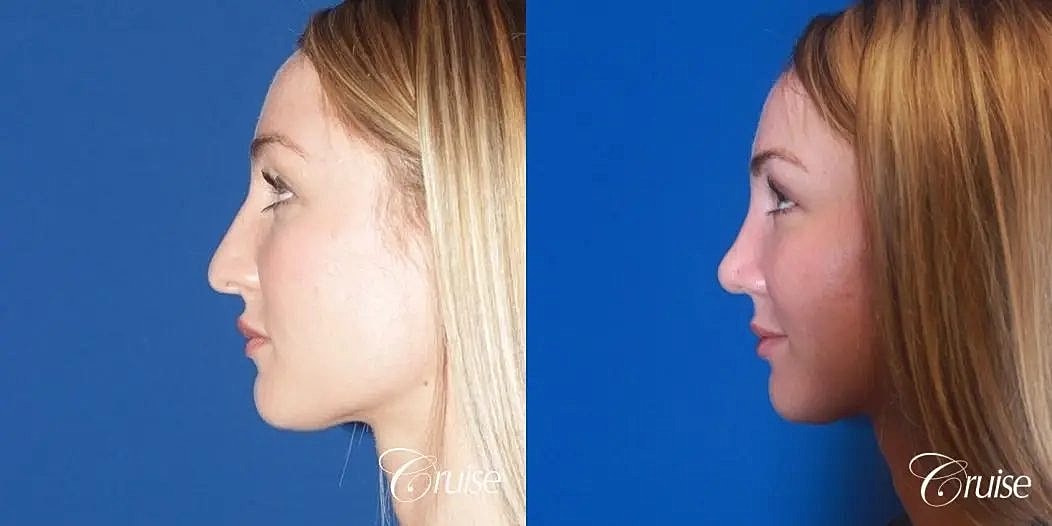 Rhinoplasty Before & After