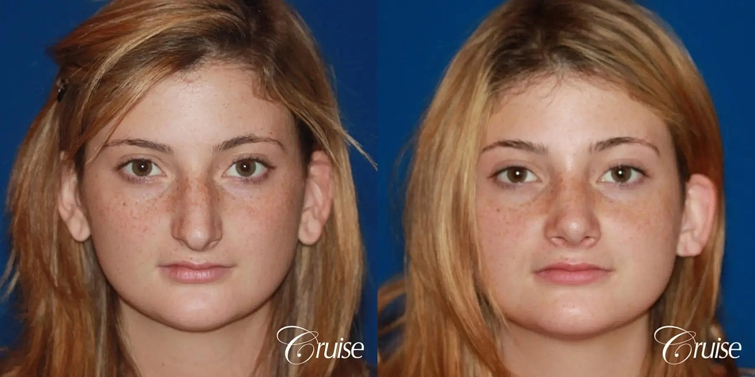 Rhinoplasty Before & After
