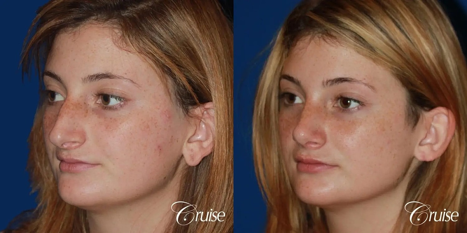 Rhinoplasty Before & After