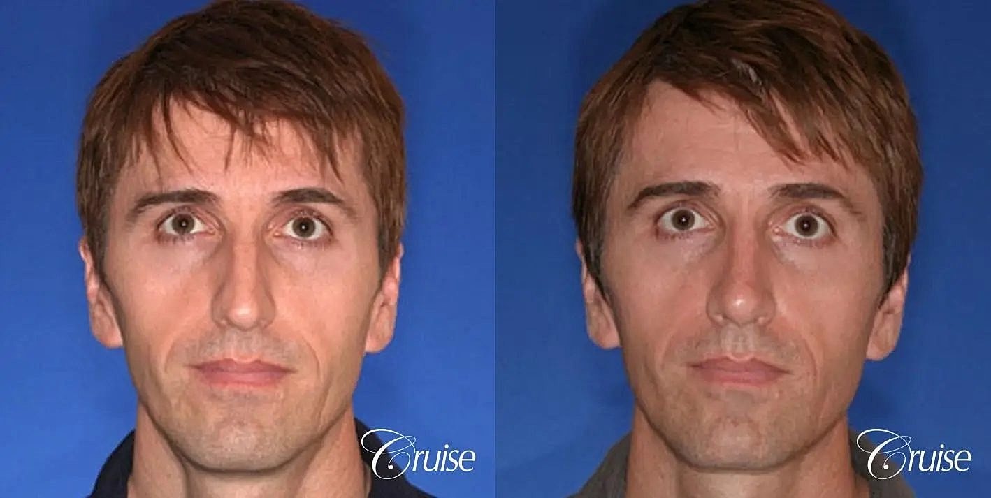 Rhinoplasty Before & After