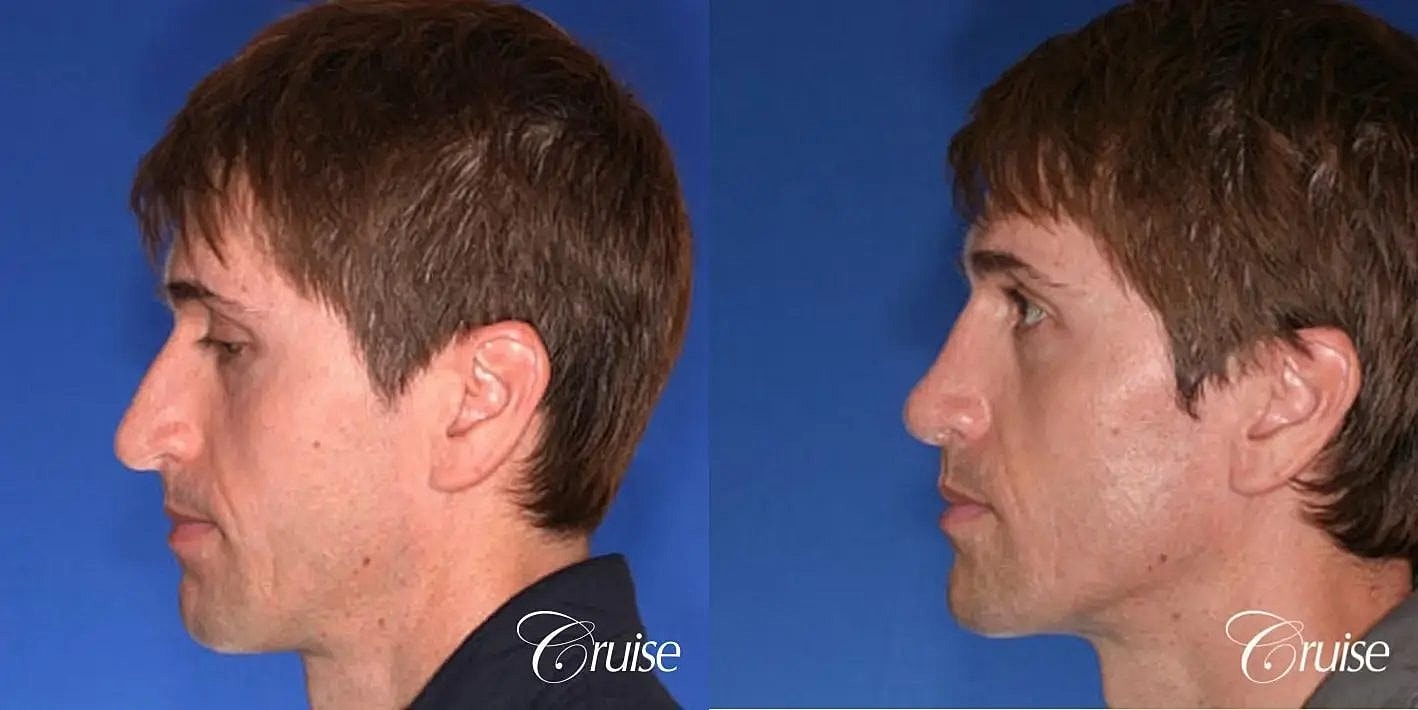 Rhinoplasty Before & After