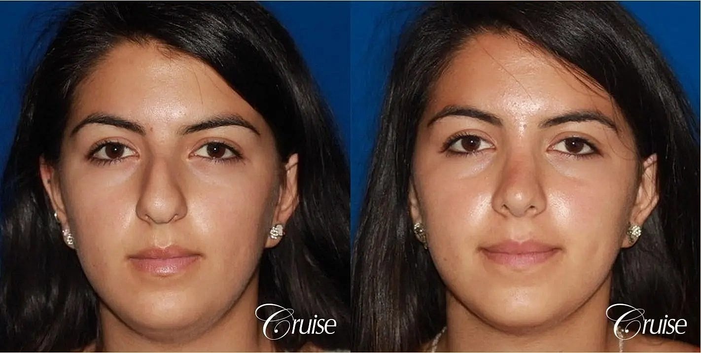 Rhinoplasty Before & After