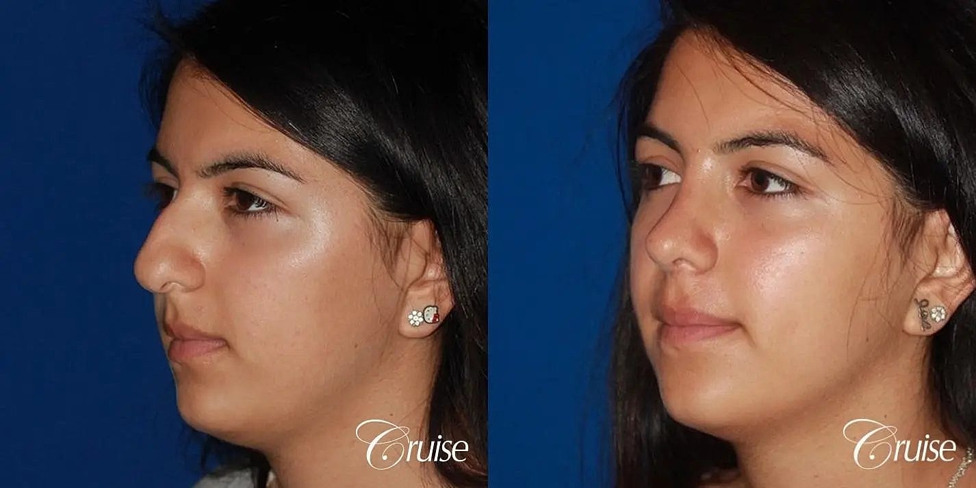 Rhinoplasty Before & After
