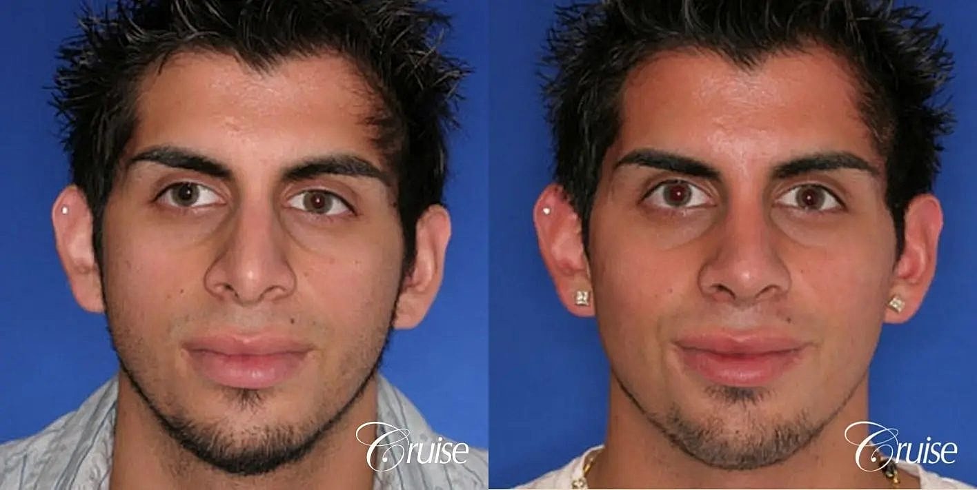 Rhinoplasty Before & After