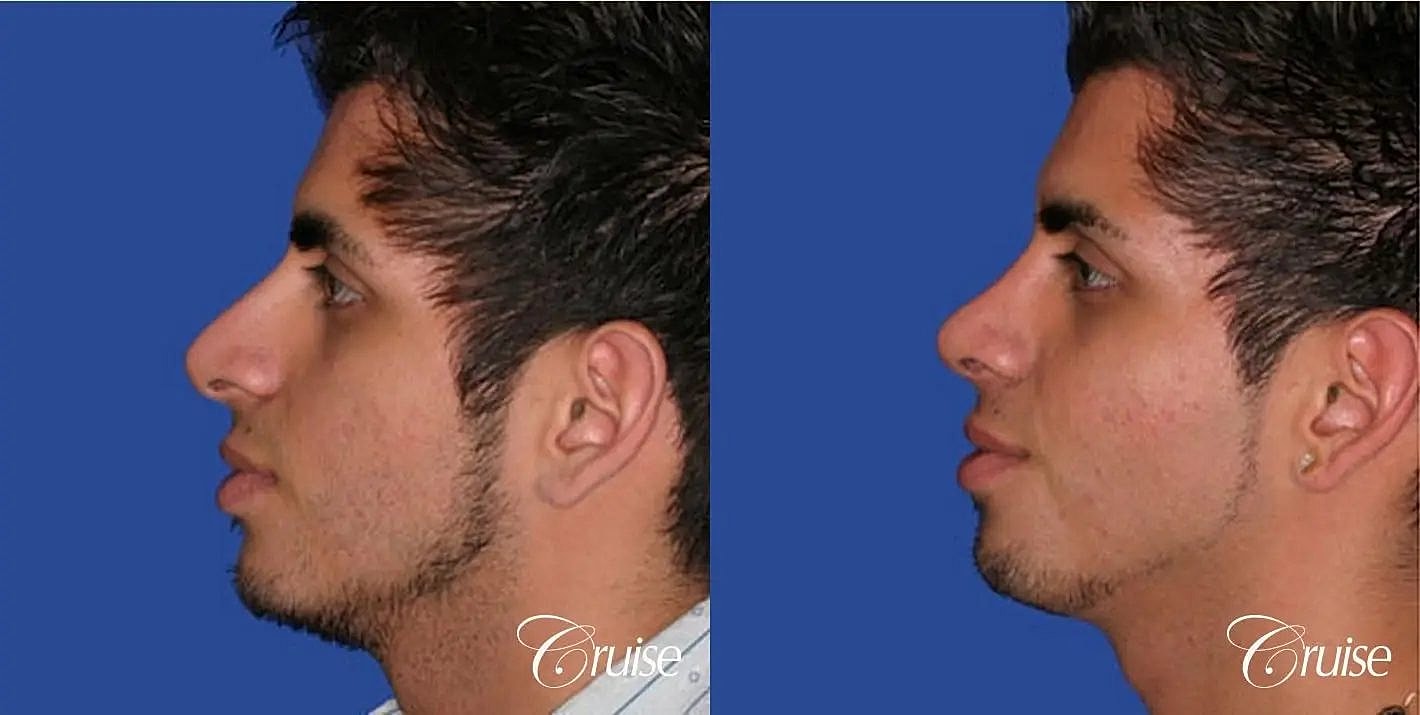 Rhinoplasty Before & After