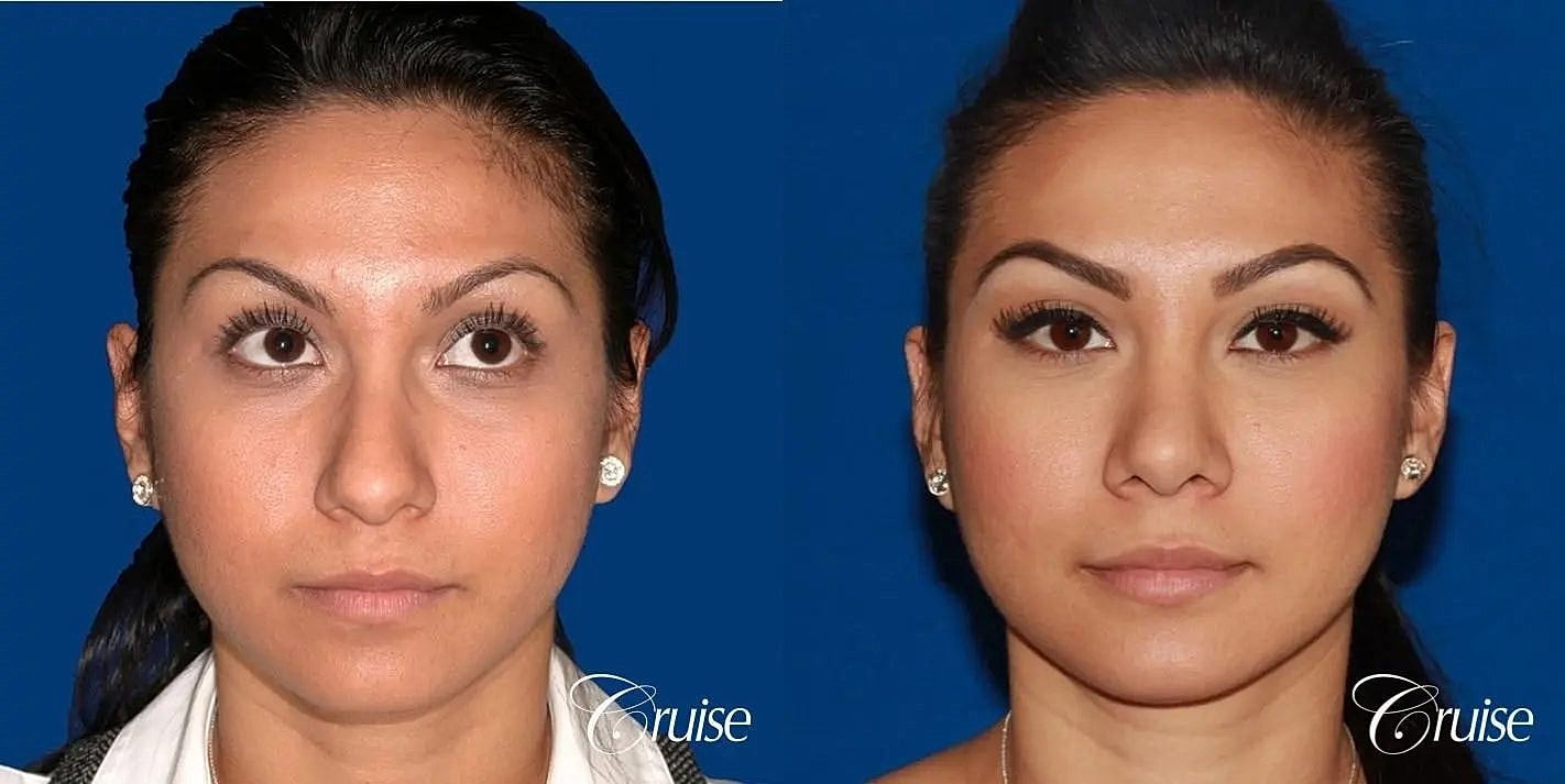 Rhinoplasty Before & After