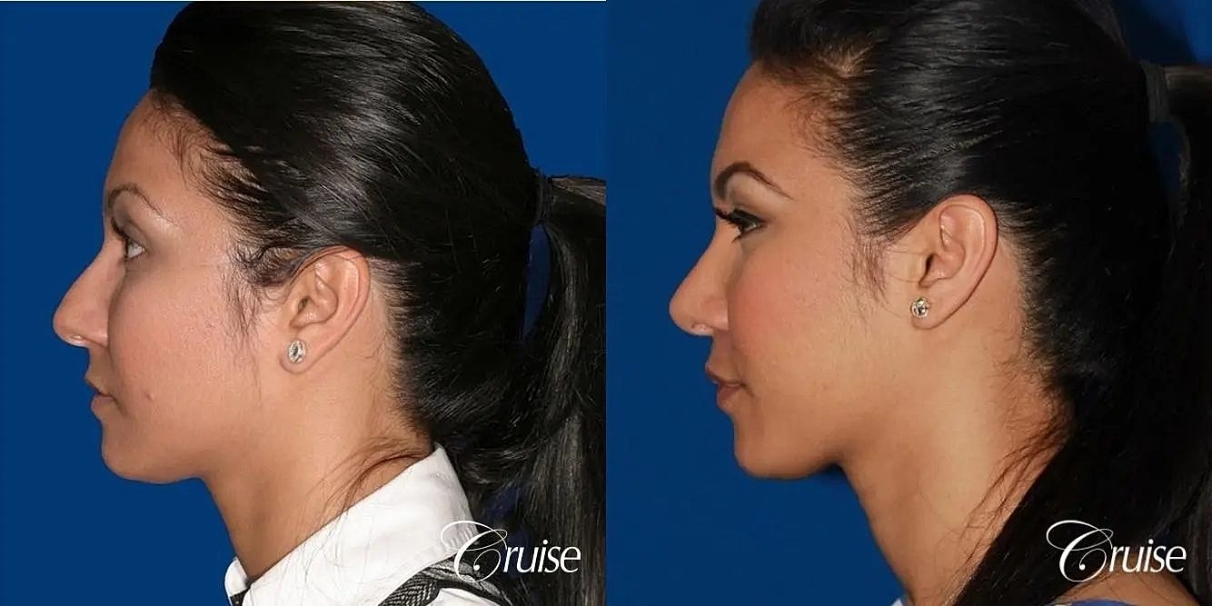 Rhinoplasty Before & After