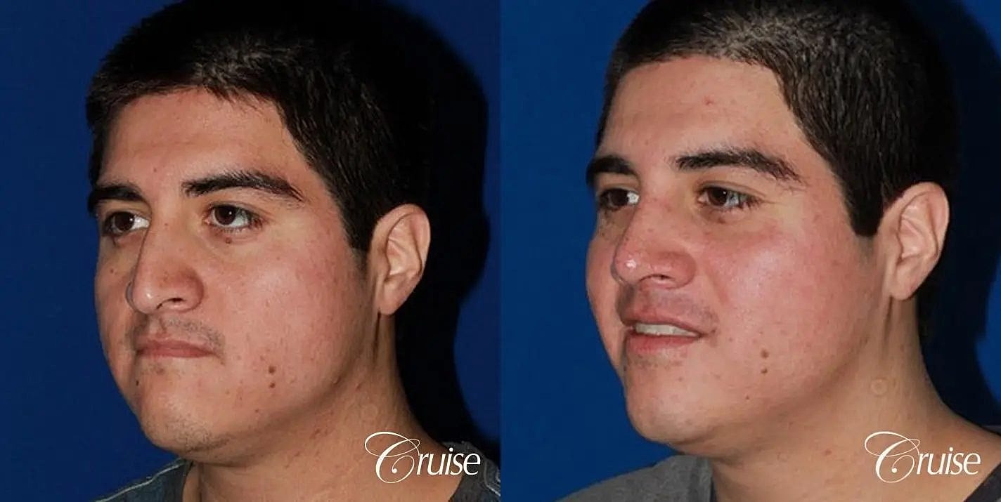 Rhinoplasty Before & After