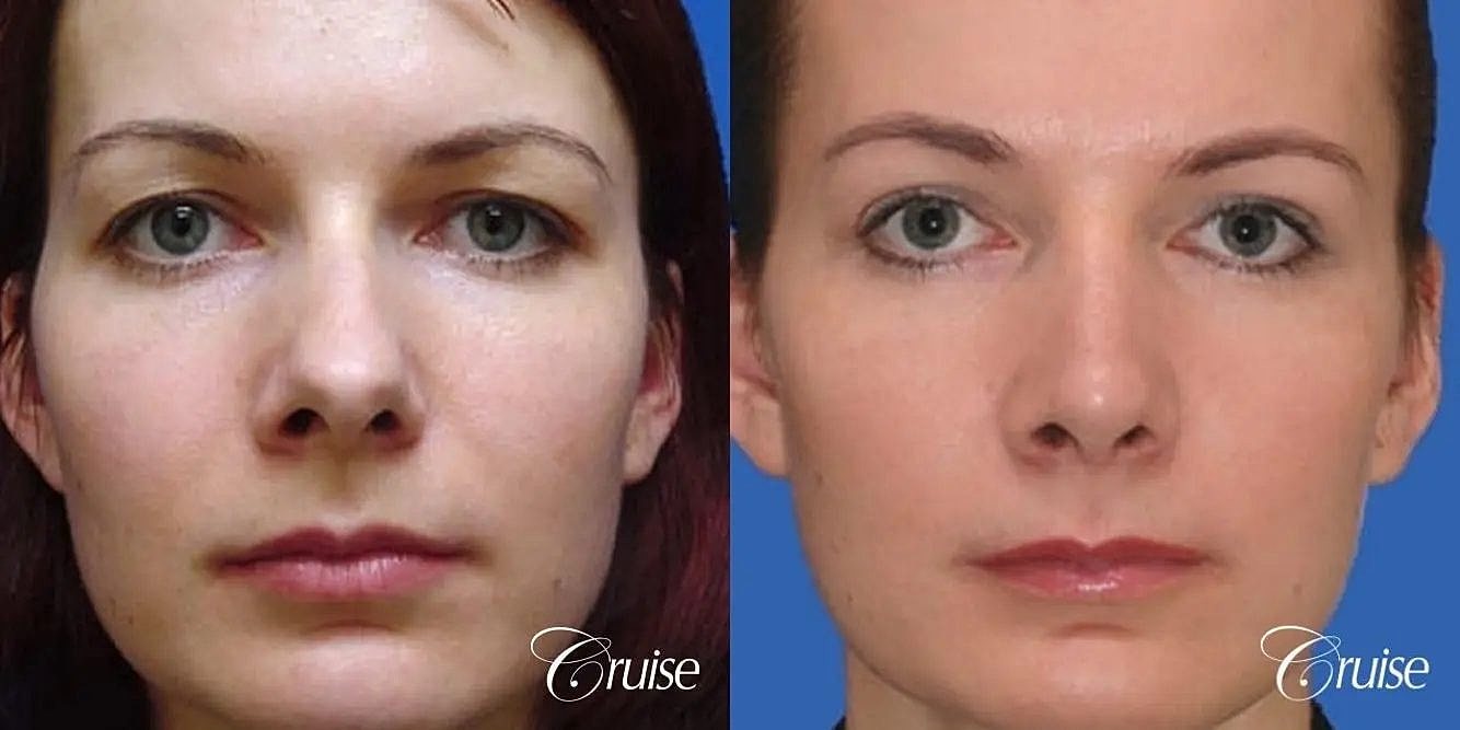 Rhinoplasty Before & After
