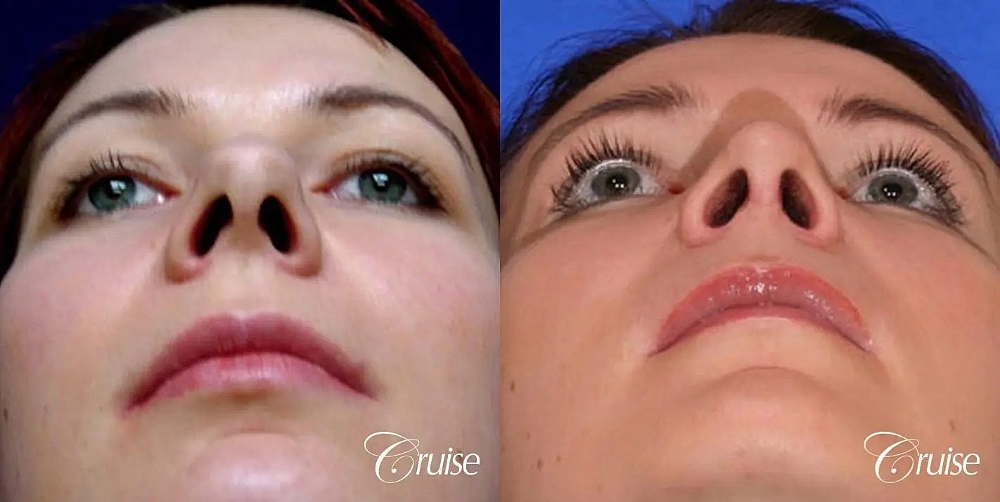 Rhinoplasty Before & After