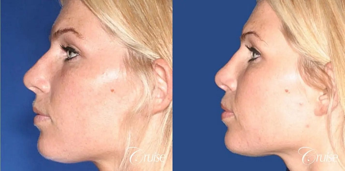 Rhinoplasty Before & After