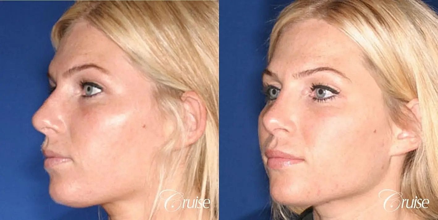 Rhinoplasty Before & After