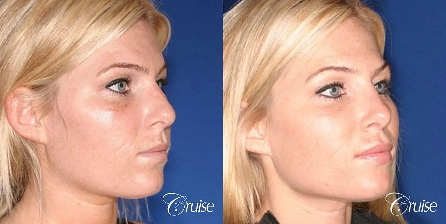 Rhinoplasty Before & After