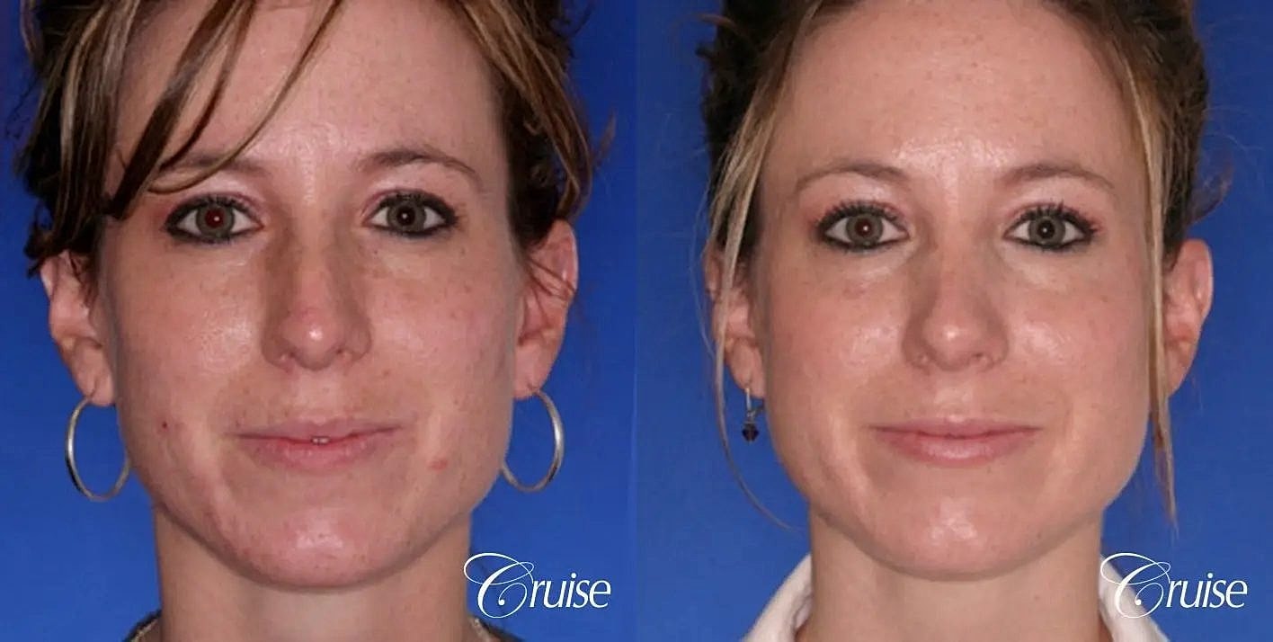 Rhinoplasty Before & After