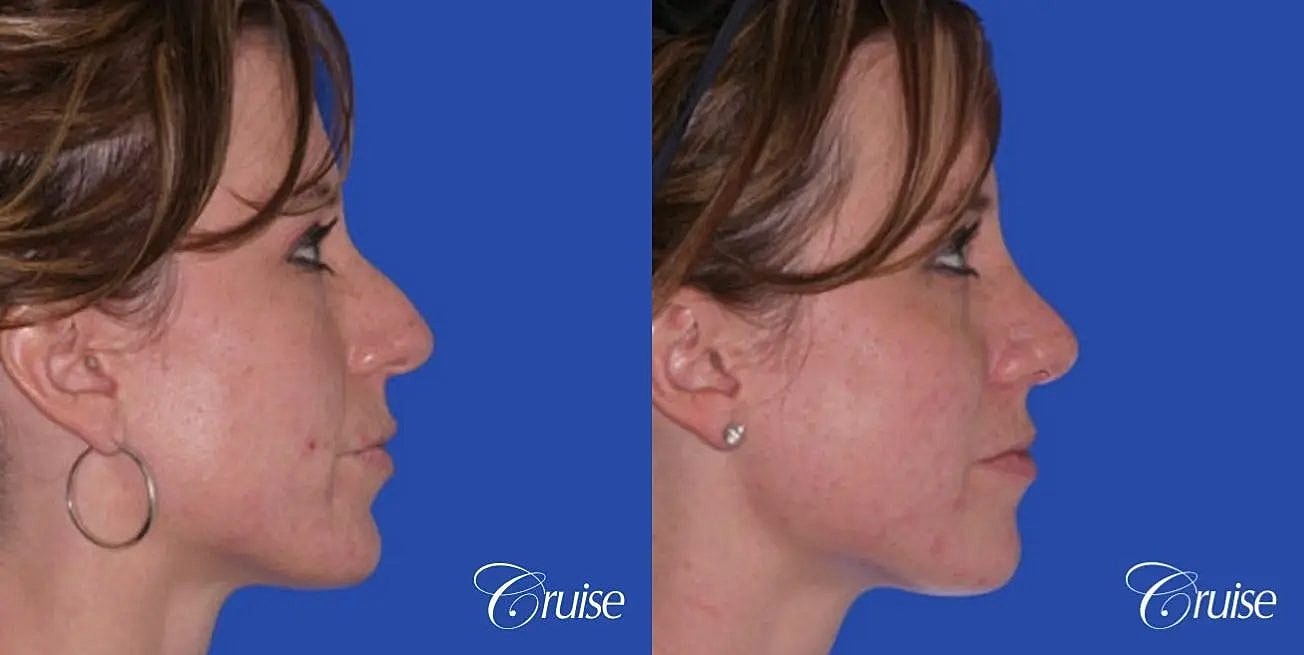 Rhinoplasty Before & After
