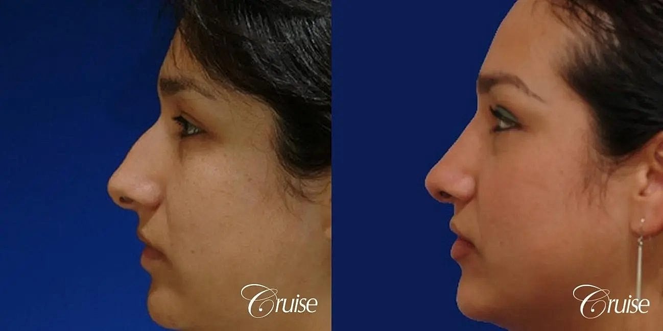 Rhinoplasty Before & After