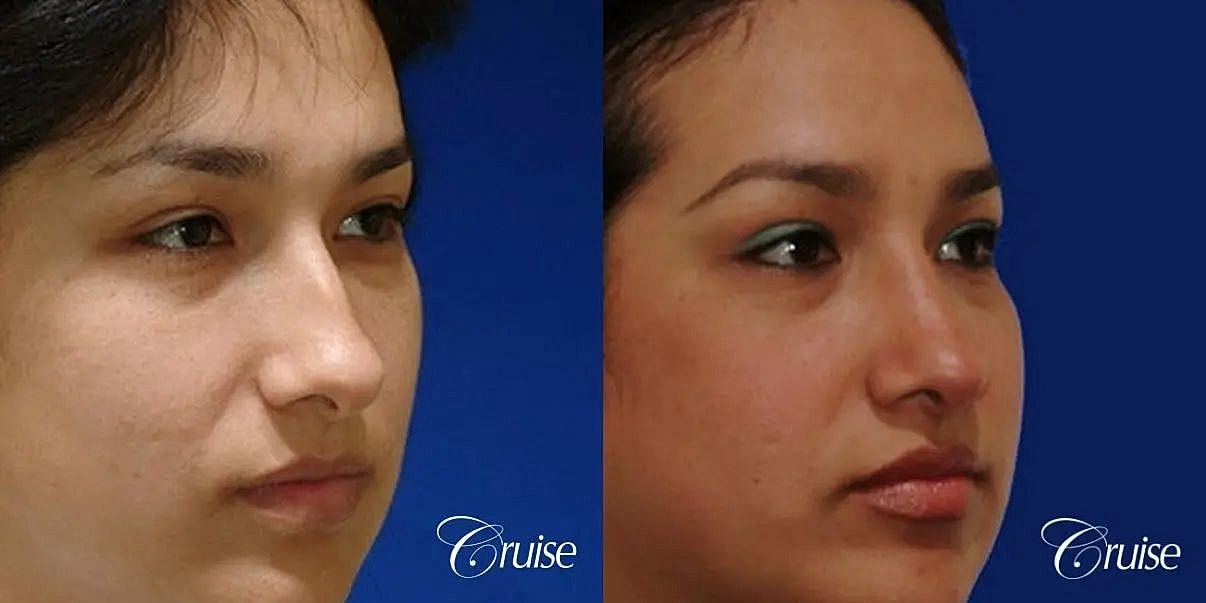 Rhinoplasty Before & After