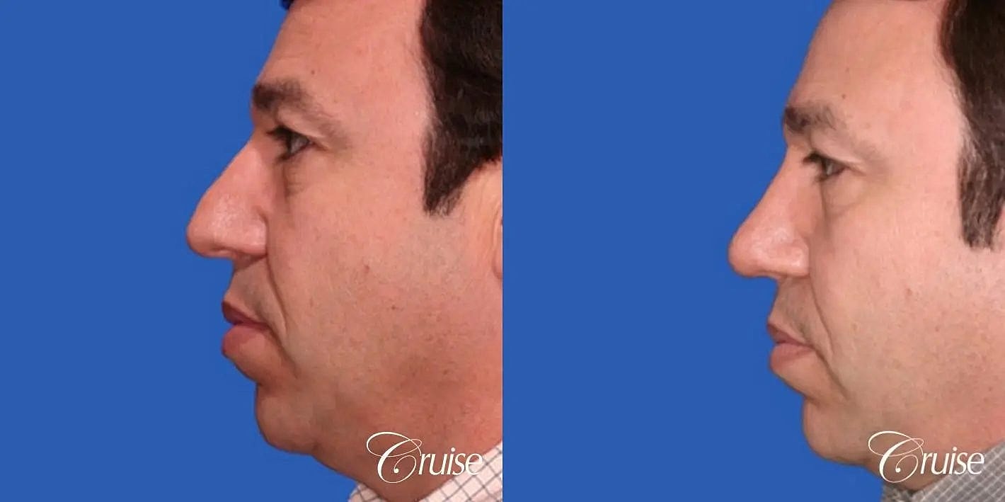 Rhinoplasty Before & After