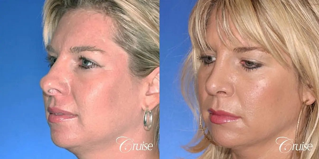 Rhinoplasty Before & After