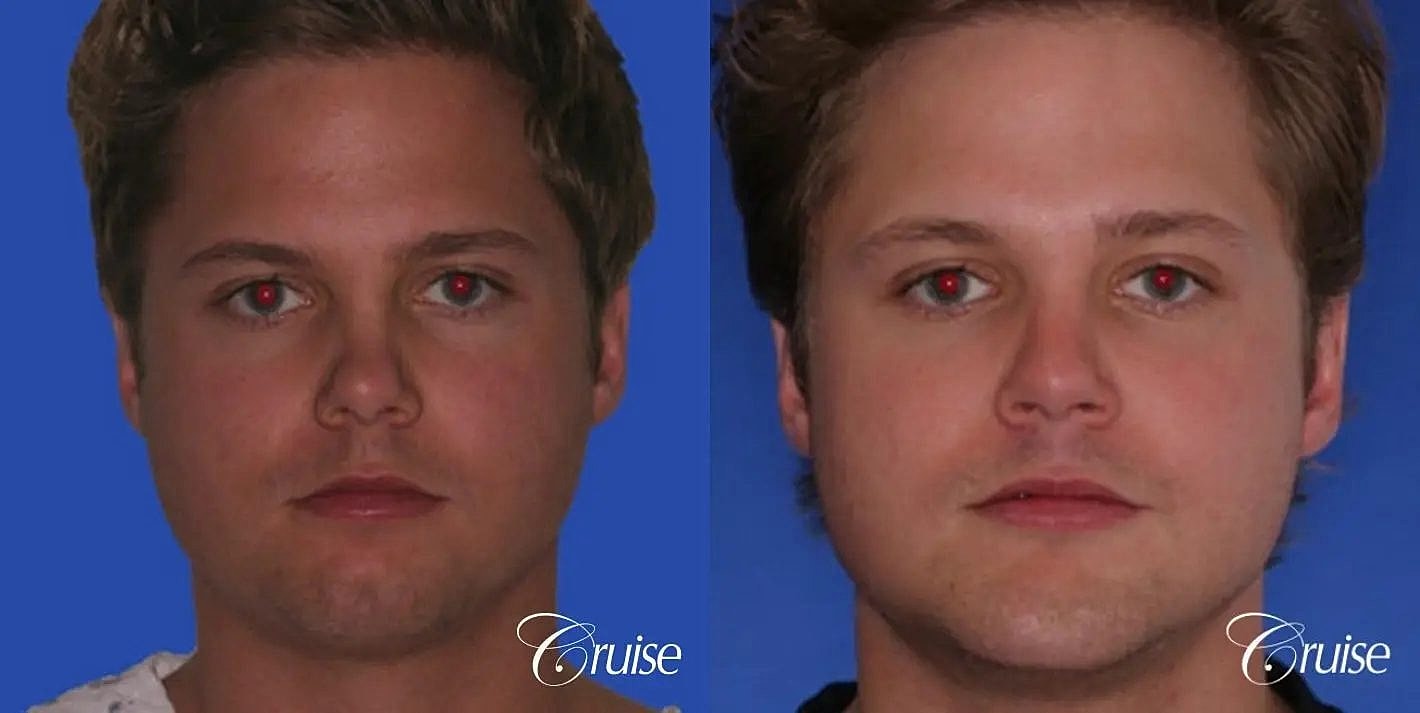 Rhinoplasty Before & After