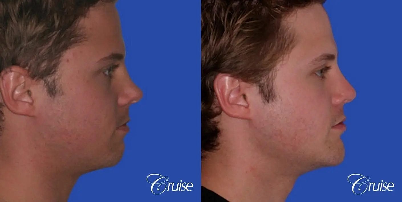 Rhinoplasty Before & After