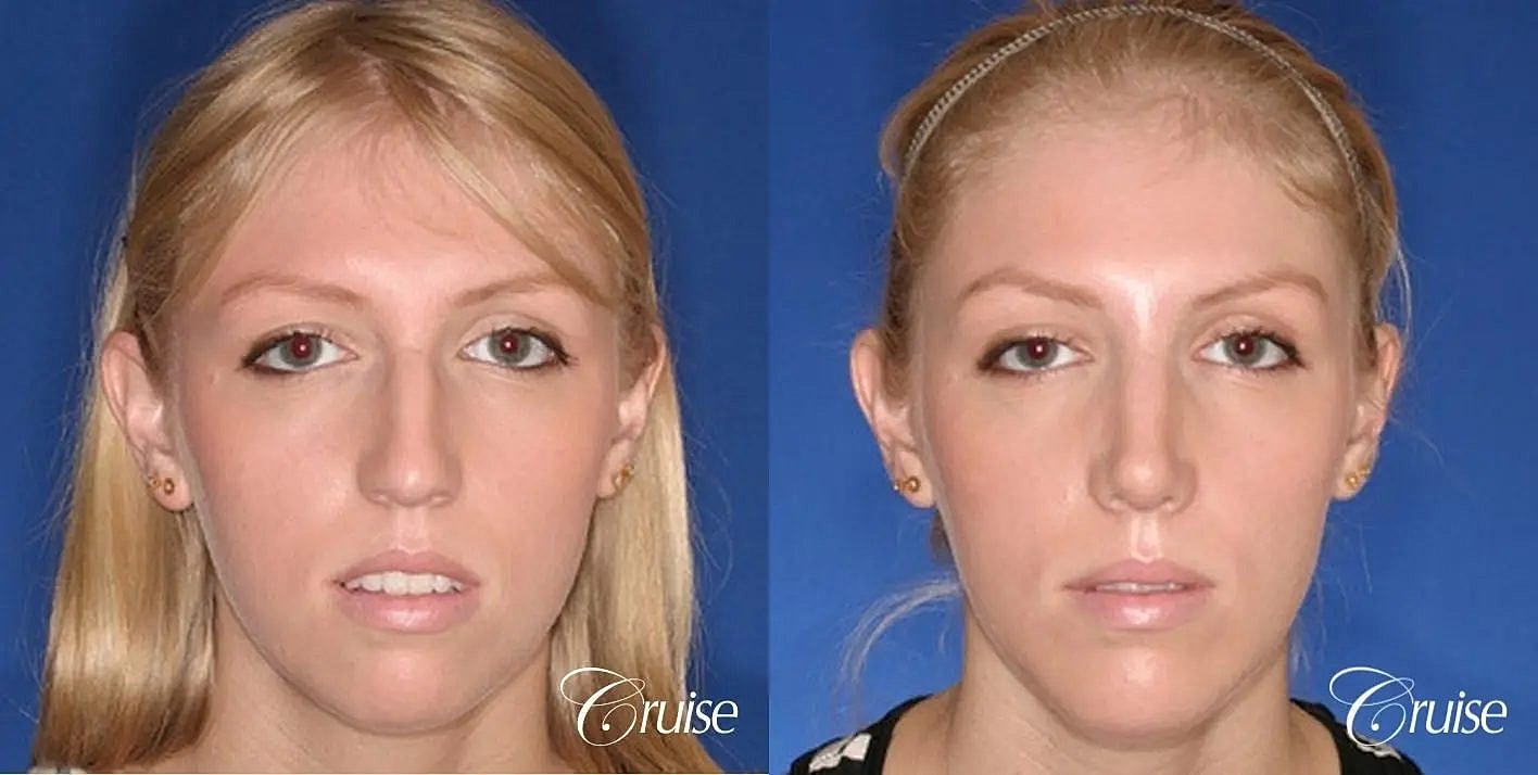 Rhinoplasty Before & After