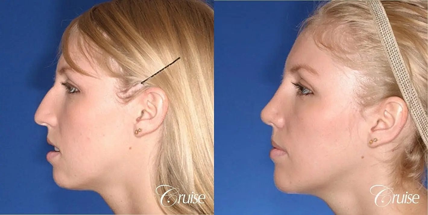 Rhinoplasty Before & After