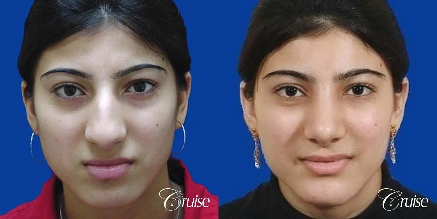 Rhinoplasty Before & After