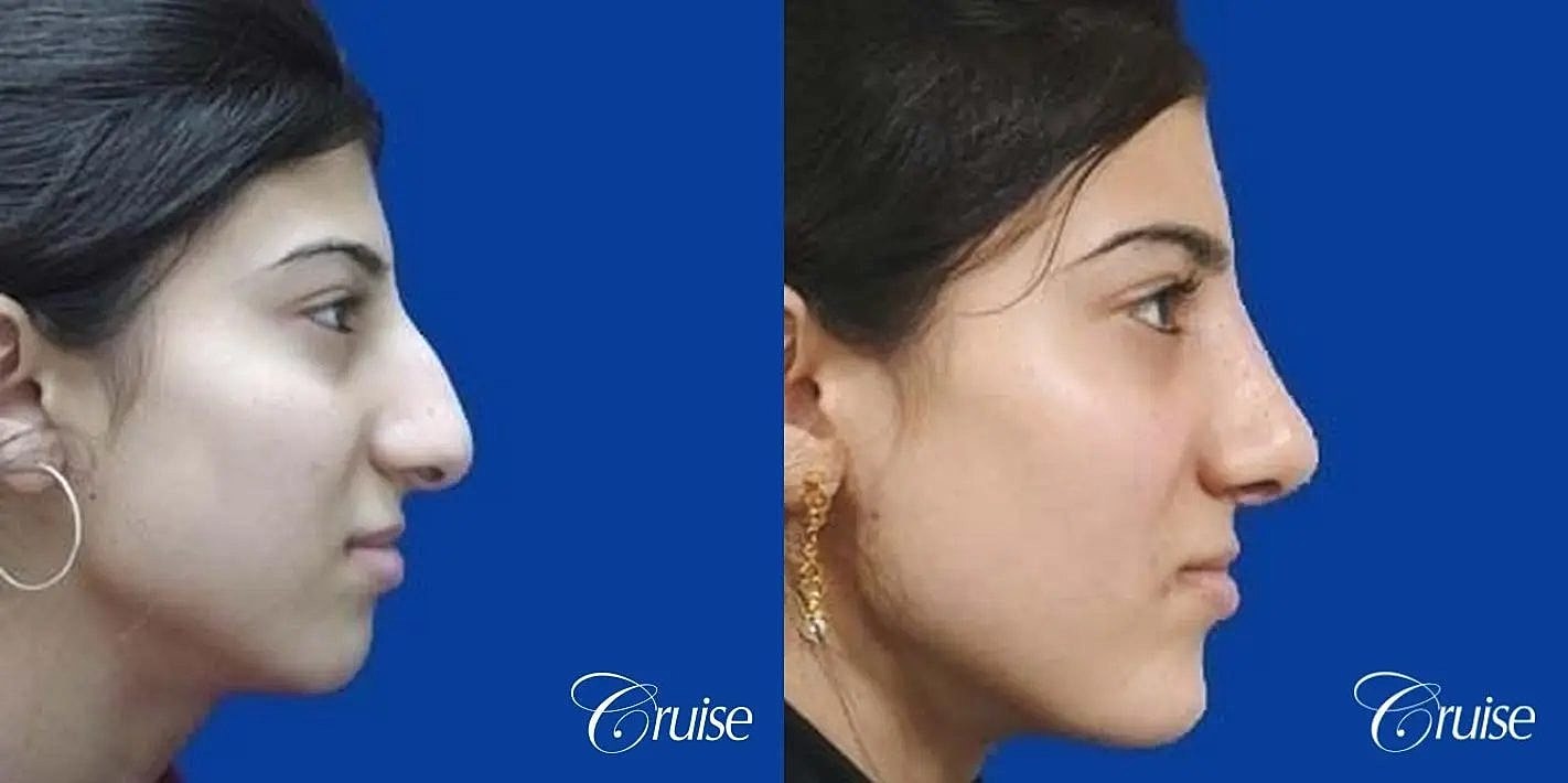 Rhinoplasty Before & After