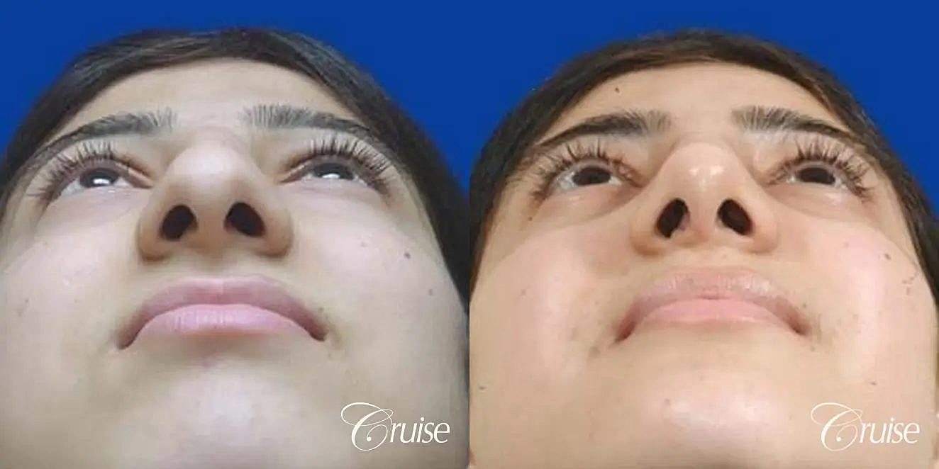 Rhinoplasty Before & After
