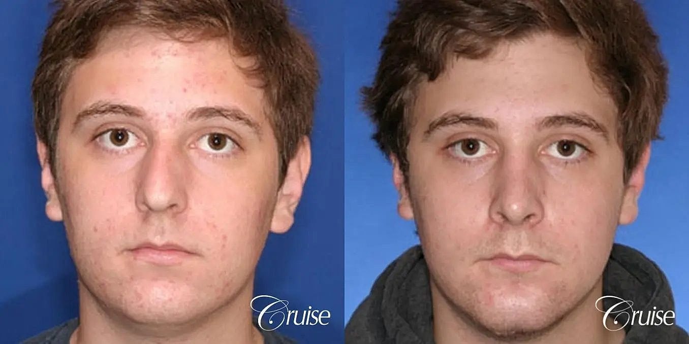 Rhinoplasty Before & After