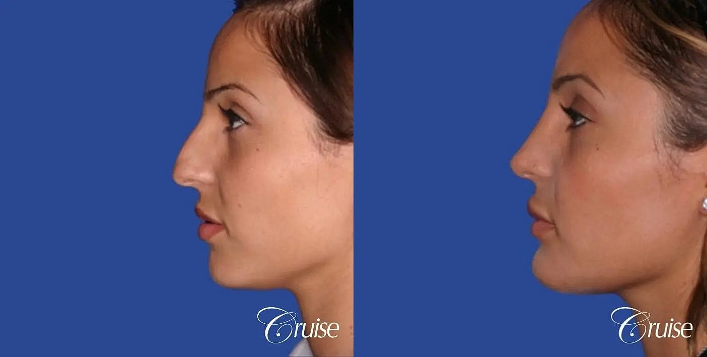 Rhinoplasty Before & After