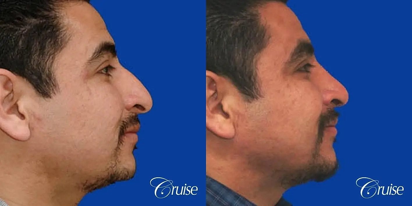 Rhinoplasty Before & After