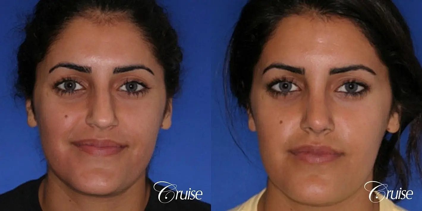 Rhinoplasty Before & After