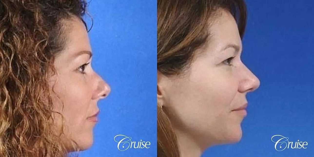 Rhinoplasty Before & After