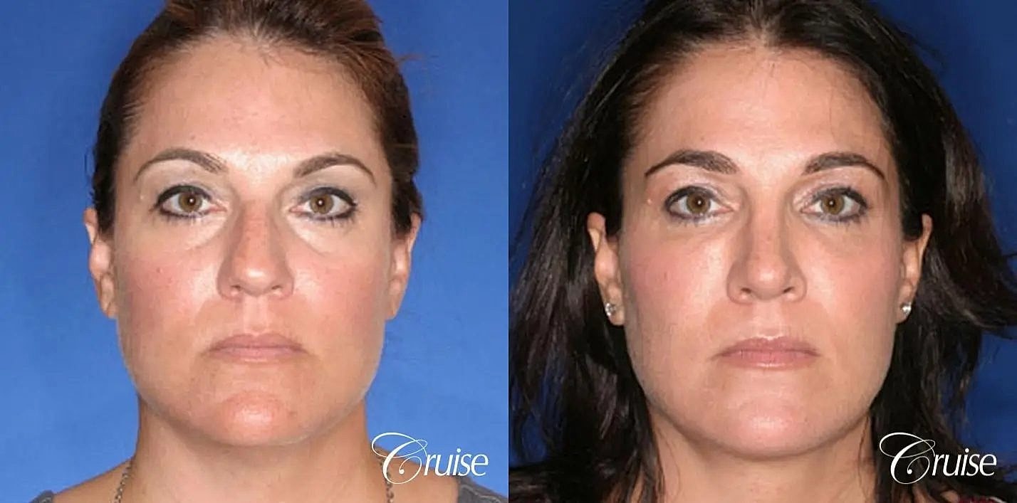 Rhinoplasty Before & After